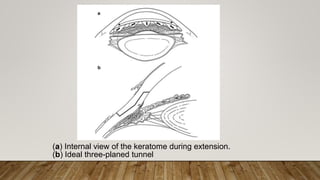 (a) Internal view of the keratome during extension.
(b) Ideal three-planed tunnel
 