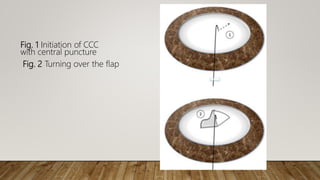 Fig. 1 Initiation of CCC
with central puncture
Fig. 2 Turning over the flap
 
