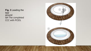 Fig. 3 Leading the
tear
around
&4 The completed
CCC with PCIOL
 