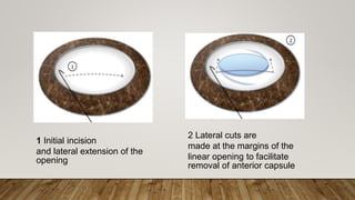 1 Initial incision
and lateral extension of the
opening
2 Lateral cuts are
made at the margins of the
linear opening to facilitate
removal of anterior capsule
 