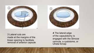 4 The lateral edge
of the capsulotomy is
engaged with the Simcoe
cannula, a cystotome, or
Utrata forcep
3 Lateral cuts are
made at the margins of the
linear opening to facilitate
removal of anterior capsule
 