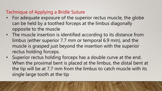 Technique of Applying a Bridle Suture
• For adequate exposure of the superior rectus muscle, the globe
can be held by a toothed forceps at the limbus diagonally
opposite to the muscle
• The muscle insertion is identified according to its distance from
limbus (either superior 7.7 mm or temporal 6.9 mm), and the
muscle is grasped just beyond the insertion with the superior
rectus holding forceps.
• Superior rectus holding forceps has a double curve at the end.
When the proximal bent is placed at the limbus, the distal bent at
the tip will be at 7.7 mm from the limbus to catch muscle with its
single large tooth at the tip
 