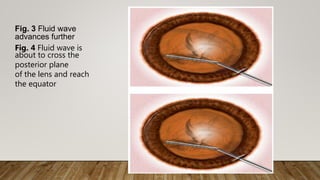Fig. 3 Fluid wave
advances further
Fig. 4 Fluid wave is
about to cross the
posterior plane
of the lens and reach
the equator
 