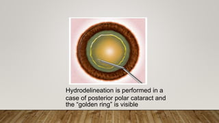 Hydrodelineation is performed in a
case of posterior polar cataract and
the “golden ring” is visible
 