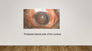Prolapsed lateral pole of the nucleus
 