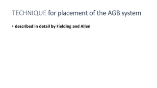 TECHNIQUE for placement of the AGB system
• described in detail by Fielding and Allen
 