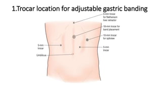 1.Trocar location for adjustable gastric banding
 