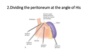 2.Dividing the peritoneum at the angle of His
 