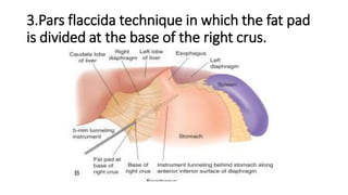 3.Pars flaccida technique in which the fat pad
is divided at the base of the right crus.
 