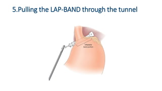 5.Pulling the LAP-BAND through the tunnel
 