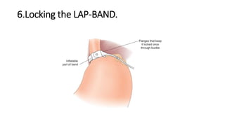 6.Locking the LAP-BAND.
 