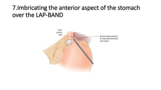 7.Imbricating the anterior aspect of the stomach
over the LAP-BAND
 