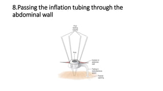 8.Passing the inflation tubing through the
abdominal wall
 