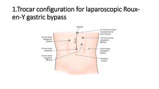 1.Trocar configuration for laparoscopic Roux-
en-Y gastric bypass
 