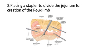 2.Placing a stapler to divide the jejunum for
creation of the Roux limb
 