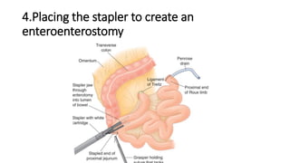 4.Placing the stapler to create an
enteroenterostomy
 