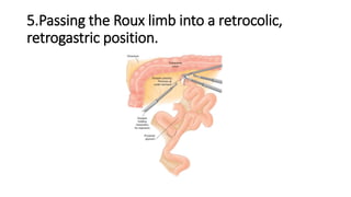 5.Passing the Roux limb into a retrocolic,
retrogastric position.
 
