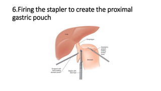 6.Firing the stapler to create the proximal
gastric pouch
 