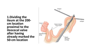 1.Dividing the
ileum at the 200-
cm location
proximal to the
ileocecal valve
after having
already marked the
50-cm location
 