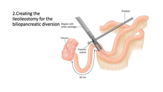 2.Creating the
ileoileostomy for the
biliopancreatic diversion
 