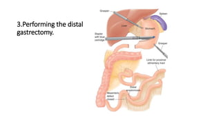 3.Performing the distal
gastrectomy.
 