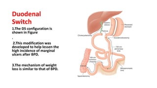 Duodenal
Switch
1.The DS configuration is
shown in Figure
.
2.This modification was
developed to help lessen the
high incidence of marginal
ulcers after BPD.
3.The mechanism of weight
loss is similar to that of BPD.
 