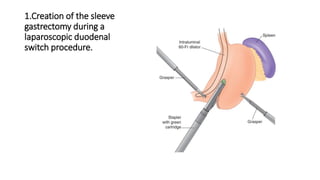 1.Creation of the sleeve
gastrectomy during a
laparoscopic duodenal
switch procedure.
 