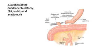2.Creation of the
duodenoenterostomy.
EEA, end-to-end
anastomosis
 