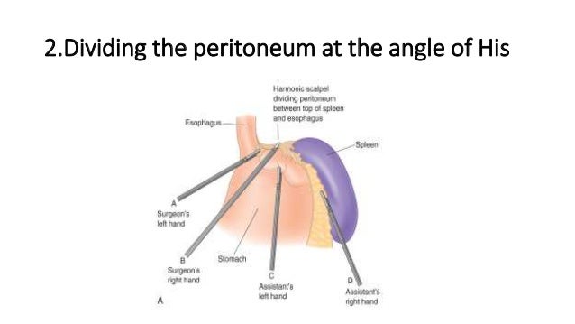 bariatric surgery