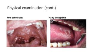 Physical examination (cont.)
Oral candidiasis Hairy leukoplakia
 