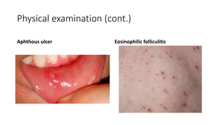 Physical examination (cont.)
Aphthous ulcer Eosinophilic folliculitis
 
