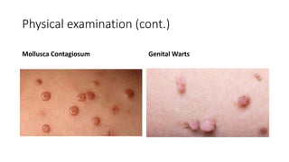 Physical examination (cont.)
Mollusca Contagiosum Genital Warts
 