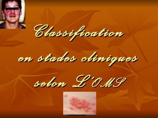 Classification en stades cliniques selon L’ OMS 