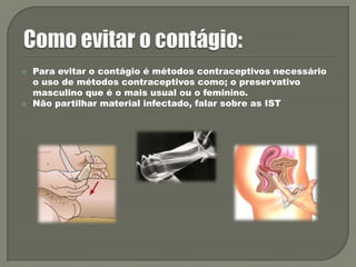 Como evitar o contágio:Para evitar o contágio é métodos contraceptivos necessário o uso de métodos contraceptivos como; o preservativo masculino que é o mais usual ou o feminino.Não partilhar material infectado, falar sobre as IST