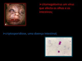citomegalovirus um vírus
                           que afecta os olhos e os
                           intestinos;




criptosporidiose, uma doença intestinal;
 