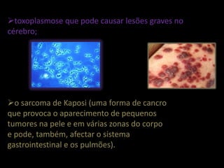 toxoplasmose que pode causar lesões graves no
cérebro;




o sarcoma de Kaposi (uma forma de cancro
que provoca o aparecimento de pequenos
tumores na pele e em várias zonas do corpo
e pode, também, afectar o sistema
gastrointestinal e os pulmões).
 