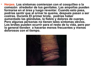 • Herpes. Los síntomas comienzan con el cosquilleo o la
  comezón alrededor de tus genitales. Las ampollas pueden
  formarse en el área y luego reventar. Cuando esto pasa,
  podrías sentir que al orinar te quema, después pasan a ser
  costras. Durante El primer brote, podrías haber
  aumentado las glándulas, la fiebre y dolores de cuerpo.
  Pero algunas personas no tienen tales síntomas obvios.
  Los brotes pueden ocurrir para el resto de tu vida, pero por
  lo general tienden a hacerse menos frecuentes y menos
  dolorosos con el tiempo.
 