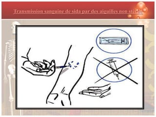 Transmission sanguine de sida par des aiguilles non stérile
 