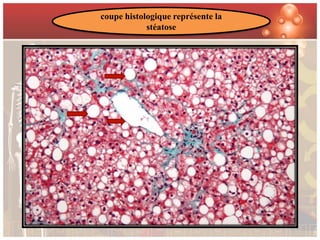 coupe histologique représente la
            stéatose
 
