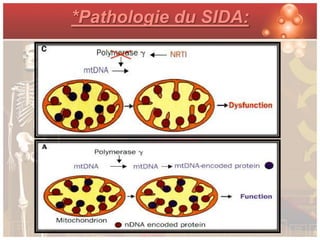 *Pathologie du SIDA:
 