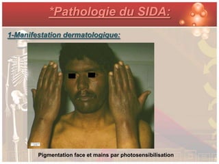 *Pathologie du SIDA:
1-Manifestation dermatologique:




        Pigmentation face et mains par photosensibilisation
 