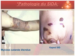 *Pathologie du SIDA:




                          Kaposi SID
Mycose cutanée étendue
 