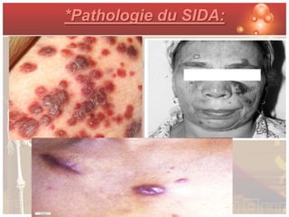 *Pathologie du SIDA:
 