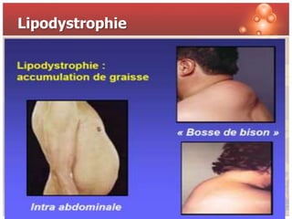 Lipodystrophie
 