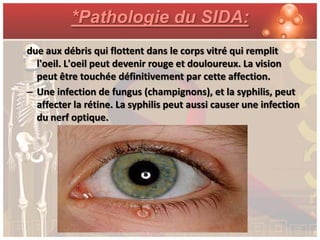 *Pathologie du SIDA:
due aux débris qui flottent dans le corps vitré qui remplit
  l'oeil. L'oeil peut devenir rouge et douloureux. La vision
  peut être touchée définitivement par cette affection.
– Une infection de fungus (champignons), et la syphilis, peut
  affecter la rétine. La syphilis peut aussi causer une infection
  du nerf optique.
 