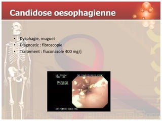 Candidose oesophagienne


• Dysphagie, muguet
• Diagnostic : fibroscopie
• Traitement : fluconazole 400 mg/j
 