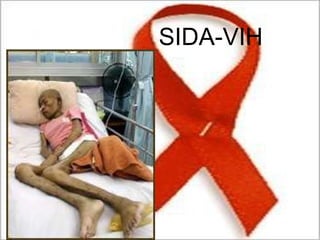 SIDA-VIH 