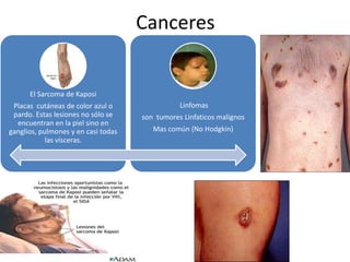 Canceres
El Sarcoma de Kaposi
Placas cutáneas de color azul o
pardo. Estas lesiones no sólo se
encuentran en la piel sino en
ganglios, pulmones y en casi todas
las vísceras.
Linfomas
son tumores Linfaticos malignos
Mas común (No Hodgkin)
 