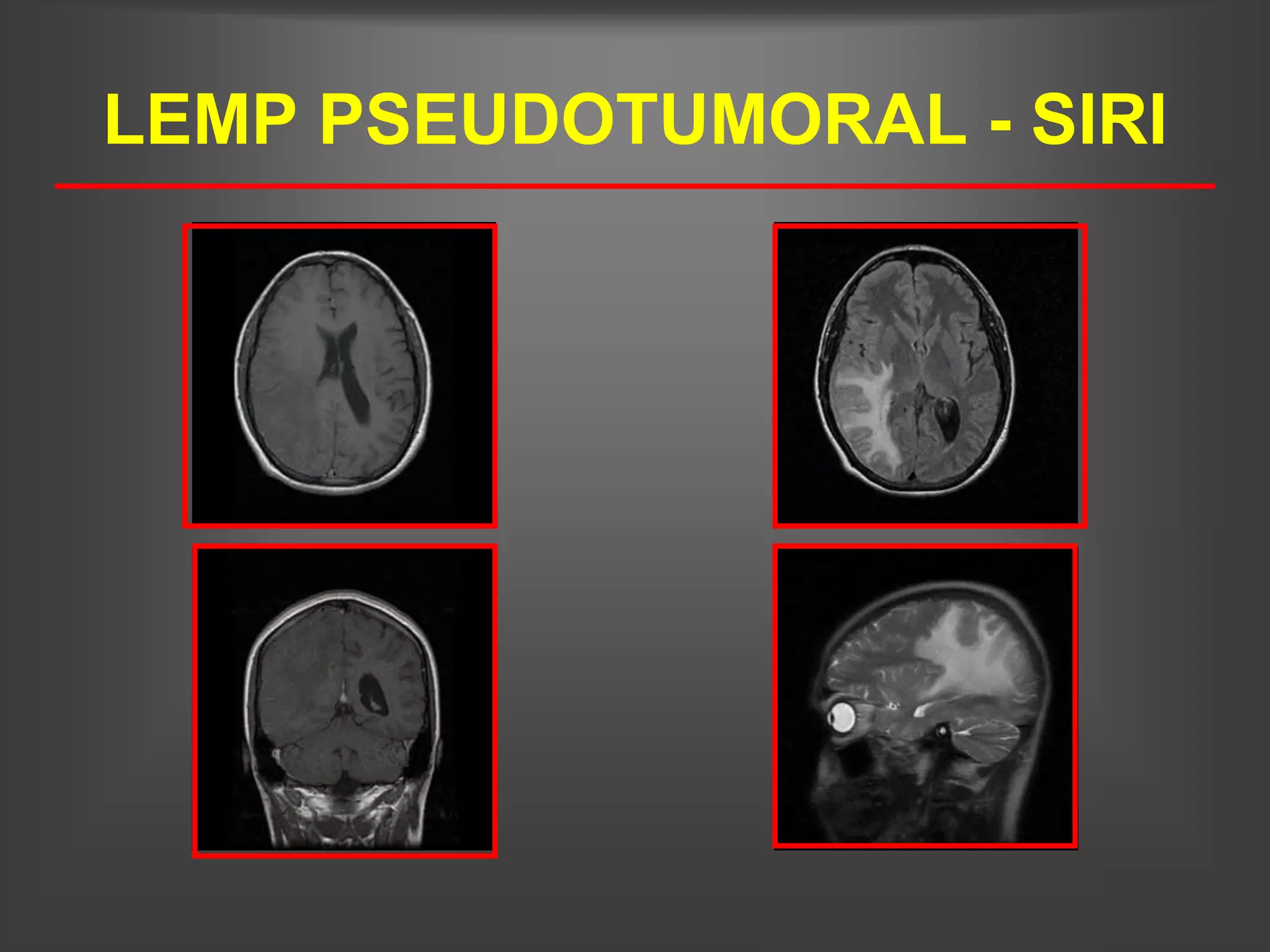LEMP PSEUDOTUMORAL - SIRI
 