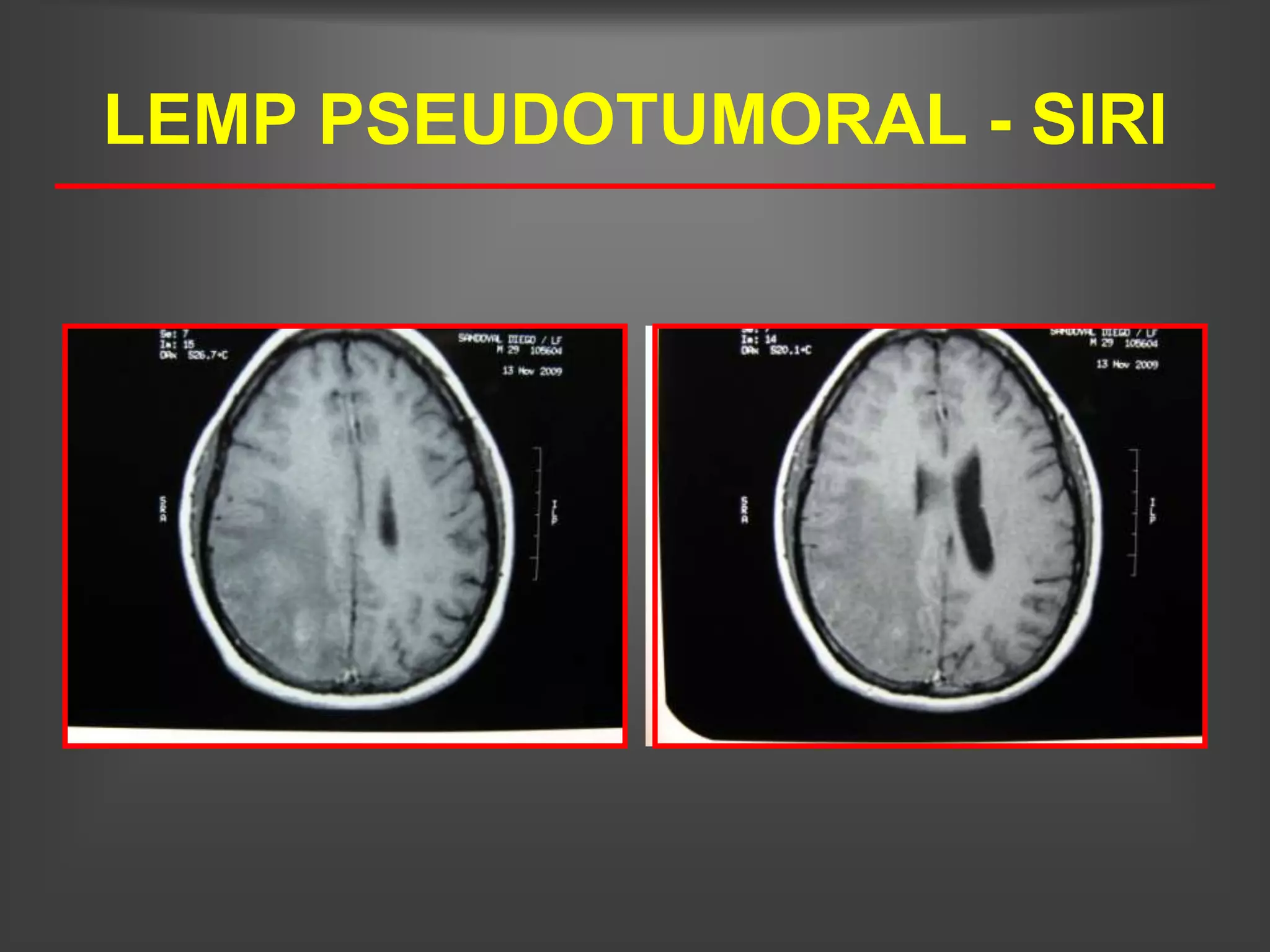 LEMP PSEUDOTUMORAL - SIRI
 